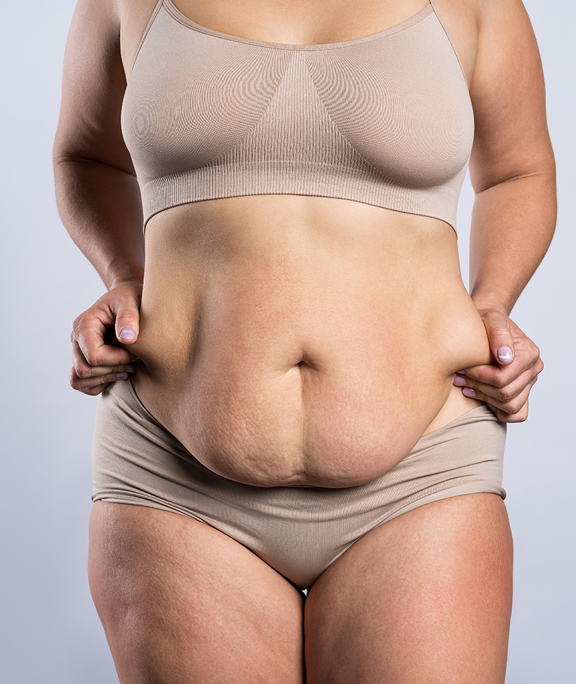 Photo of a woman with excess belly fat