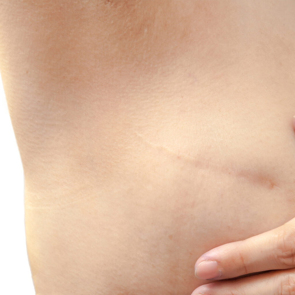 Photo of a scar on a person's body