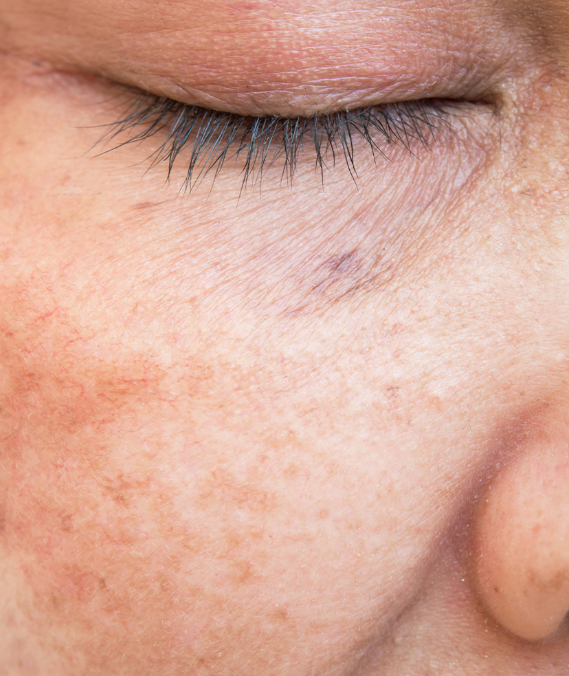 Close-up photo of sun-damaged skin