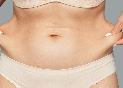 Photo of a woman tugging on the excess fat by her stomach