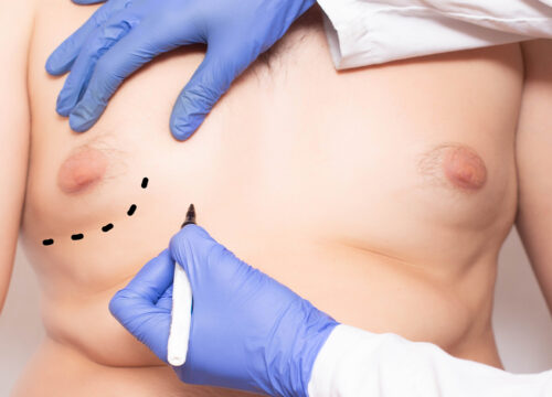 Photo of a man being prepped for gynecomastia surgery