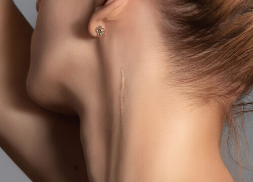 A scar on a woman's neck