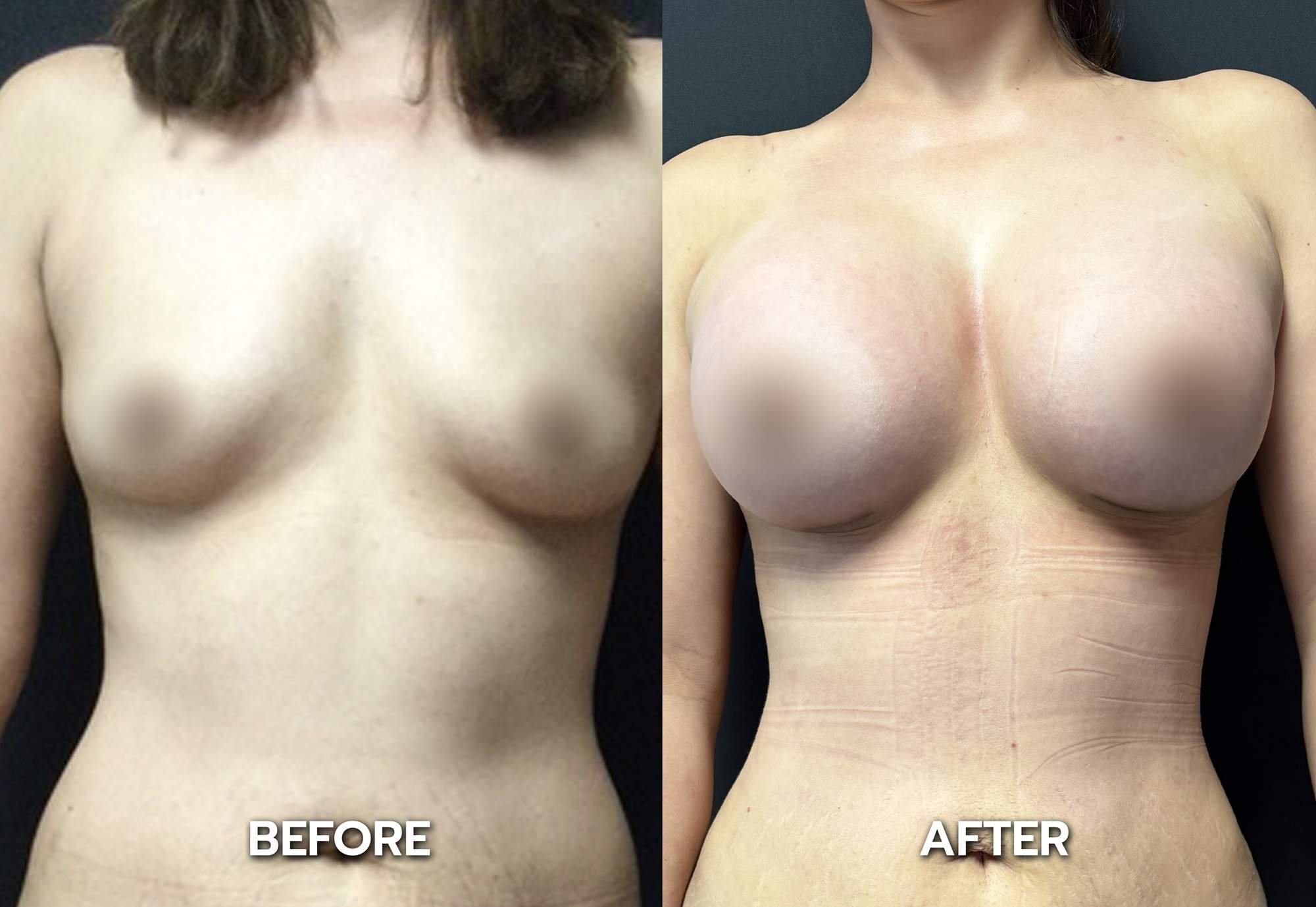 breast augmentation los angeles california before and after