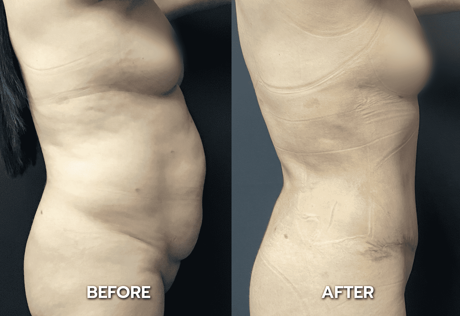 tummy tuck Los Angeles before and after
