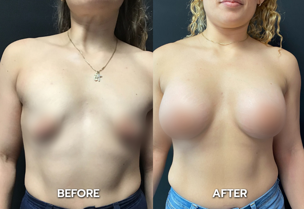 top rated breast augmentation los angeles california